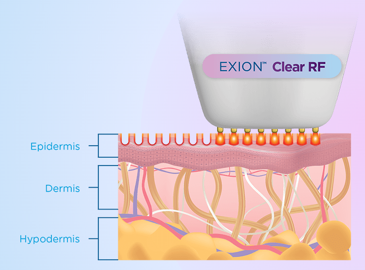 Clear RF EXION